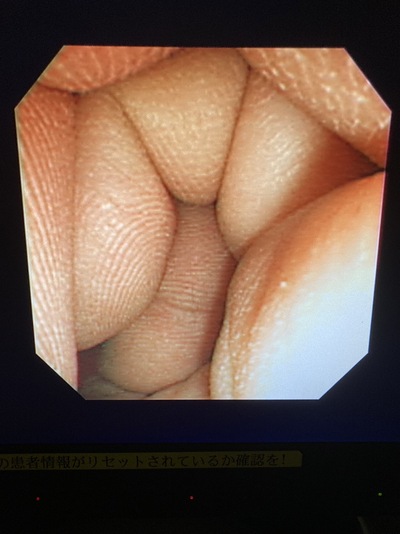 Video Gastroscope&nbsp;|&nbsp;OLYMPUS&nbsp;|&nbsp;GIF-XP260N