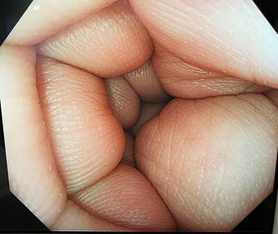 Colonoscope&nbsp;|&nbsp;OLYMPUS&nbsp;|&nbsp;CF-HQ290ZI