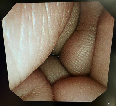 Video Duodenoscope&nbsp;|&nbsp;OLYMPUS&nbsp;|&nbsp;TJF-260V