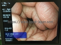 Video Gastroscope&nbsp;|&nbsp;OLYMPUS&nbsp;|&nbsp;GIF-H260