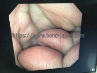 Video Gastroscope&nbsp;|&nbsp;OLYMPUS&nbsp;|&nbsp;GIF-XP170N