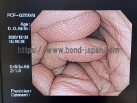 Video Colonoscope&nbsp;|&nbsp;OLYMPUS&nbsp;|&nbsp;PCF-Q260AI