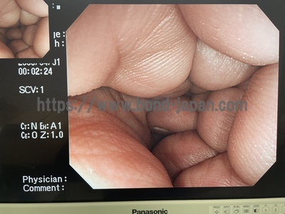 Video Colonoscope&nbsp;|&nbsp;OLYMPUS&nbsp;|&nbsp;CF-H260AI