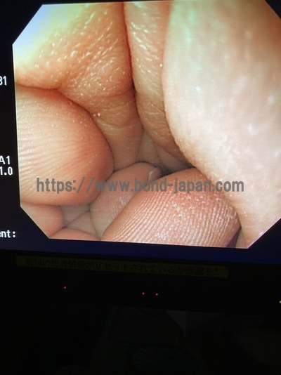 Video Gastroscope&nbsp;|&nbsp;OLYMPUS&nbsp;|&nbsp;GIF-Q240X