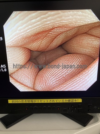 Video Colonoscope&nbsp;|&nbsp;OLYMPUS&nbsp;|&nbsp;PCF-Q240ZI