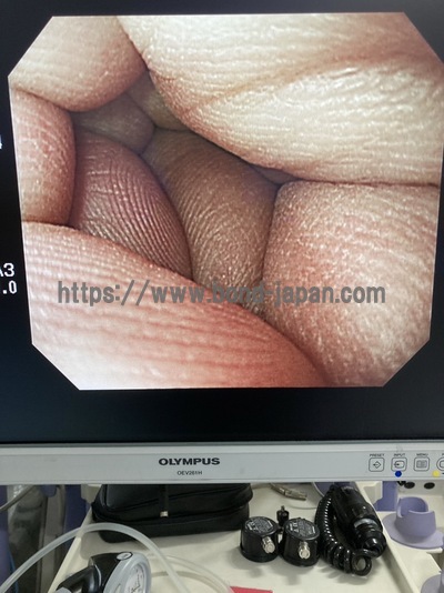 Video Gastroscope&nbsp;|&nbsp;OLYMPUS&nbsp;|&nbsp;GIF-H260