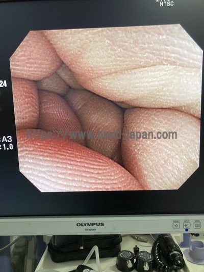 Video Colonoscope&nbsp;|&nbsp;OLYMPUS&nbsp;|&nbsp;CF-Q260AI