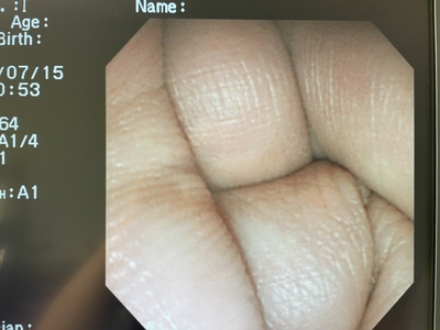 Duodenoscope&nbsp;|&nbsp;OLYMPUS&nbsp;|&nbsp;JF-230