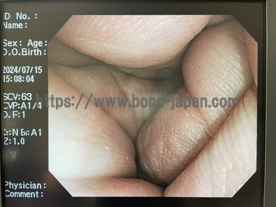 Video Colonoscope&nbsp;|&nbsp;OLYMPUS&nbsp;|&nbsp;PCF-Q260AI