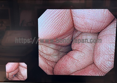 Video Gastroscope&nbsp;|&nbsp;OLYMPUS&nbsp;|&nbsp;GIF-H290Z