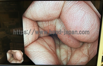 Colonoscope&nbsp;|&nbsp;OLYMPUS&nbsp;|&nbsp;CF-HQ290ZI