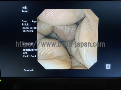 Video Gastroscope&nbsp;|&nbsp;OLYMPUS&nbsp;|&nbsp;GIF-XP170N