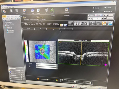  Optical Coherence Tomography ・OCT&nbsp;|&nbsp;NIDEK&nbsp;|&nbsp;RS-3000 Lite