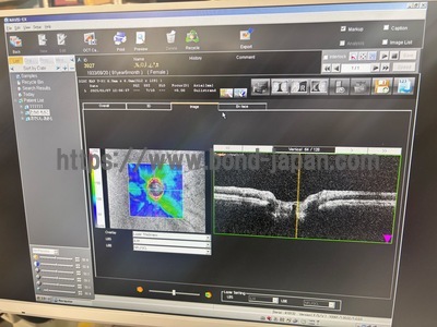  Optical Coherence Tomography ・OCT&nbsp;|&nbsp;NIDEK&nbsp;|&nbsp;RS-3000 Lite