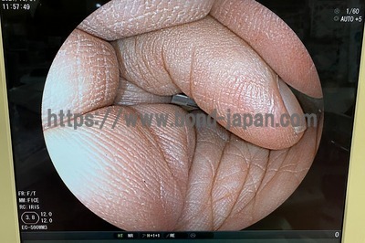 Video Colonoscope&nbsp;|&nbsp;FUJIFILM&nbsp;|&nbsp;EC-590WM3