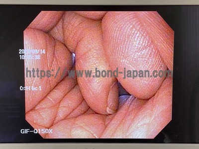 Video Gastroscope&nbsp;|&nbsp;OLYMPUS&nbsp;|&nbsp;GIF-Q150X