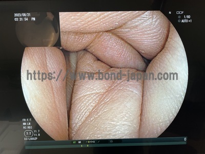 Video Colonoscope&nbsp;|&nbsp;FUJIFILM&nbsp;|&nbsp;EC-L600ZP