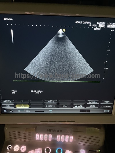 Color Doppler&nbsp;|&nbsp;HITACHI&nbsp;|&nbsp;Hi Vision Avius