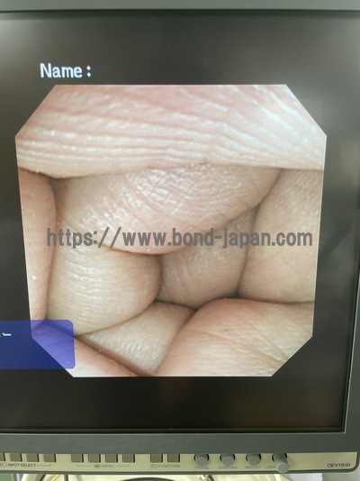 Video Colonoscope&nbsp;|&nbsp;OLYMPUS&nbsp;|&nbsp;CF-240I