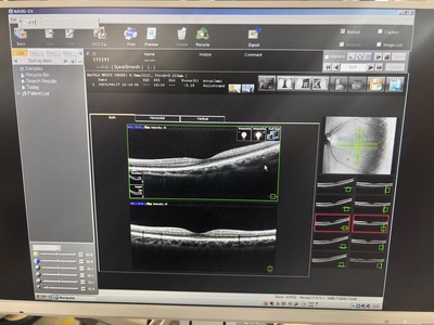  Optical Coherence Tomography ・OCT&nbsp;|&nbsp;NIDEK&nbsp;|&nbsp;RS-3000 Lite