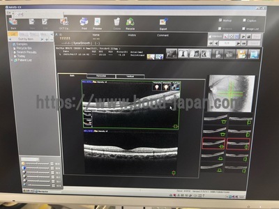  Optical Coherence Tomography ・OCT&nbsp;|&nbsp;NIDEK&nbsp;|&nbsp;RS-3000 Lite