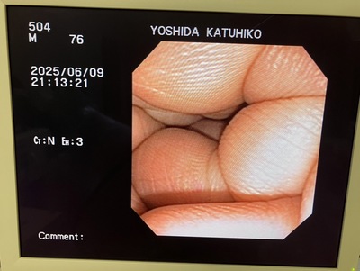 Video Gastroscope&nbsp;|&nbsp;OLYMPUS&nbsp;|&nbsp;GIF-XP150N