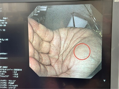 Video Duodenoscope&nbsp;|&nbsp;OLYMPUS&nbsp;|&nbsp;TJF-260V