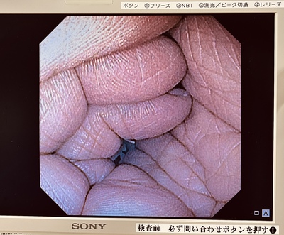 Video Gastroscope&nbsp;|&nbsp;OLYMPUS&nbsp;|&nbsp;GIF-XP170N