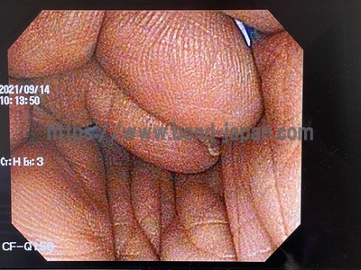 Video Gastroscope&nbsp;|&nbsp;OLYMPUS&nbsp;|&nbsp;GIF-Q150X