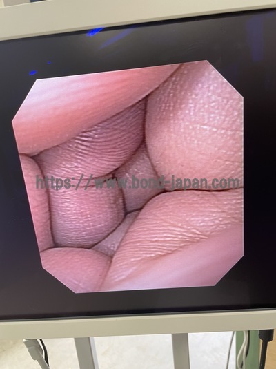 Video Gastroscope&nbsp;|&nbsp;OLYMPUS&nbsp;|&nbsp;GIF-140