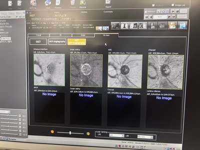  Optical Coherence Tomography ・OCT&nbsp;|&nbsp;NIDEK&nbsp;|&nbsp;RS-3000 Lite