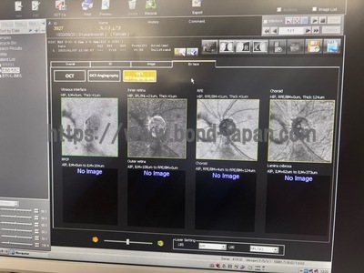  Optical Coherence Tomography ・OCT&nbsp;|&nbsp;NIDEK&nbsp;|&nbsp;RS-3000 Lite