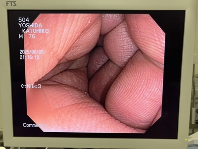 Video Colonoscope&nbsp;|&nbsp;OLYMPUS&nbsp;|&nbsp;PCF-Q150AI