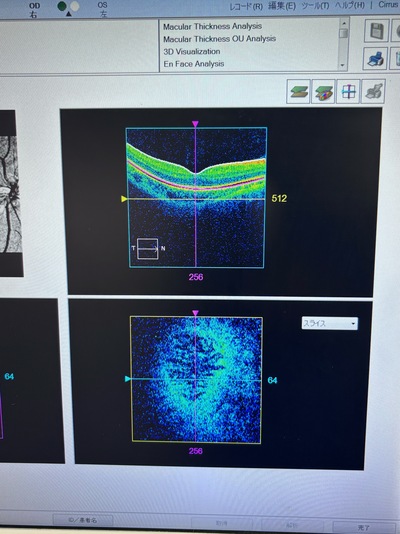 OCT&nbsp;|&nbsp;Carl Zeiss&nbsp;|&nbsp;Cirrus 500 HD-OCT Plus