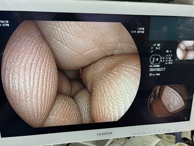 Endoscopy System&nbsp;|&nbsp;FUJIFILM&nbsp;|&nbsp;Lasereo 7000(VP-7000/LL-7000)