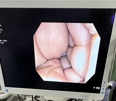 Endoscopy System&nbsp;|&nbsp;OLYMPUS&nbsp;|&nbsp;CV-170 Optera