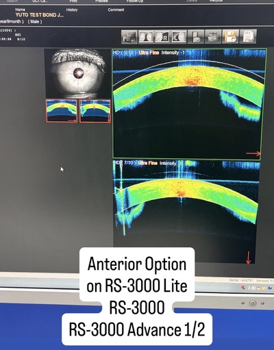 Fully Refurbished OCT with Angiography + Anterior Lens kit&nbsp;|&nbsp;NIDEK&nbsp;|&nbsp;RS-3000 Advance