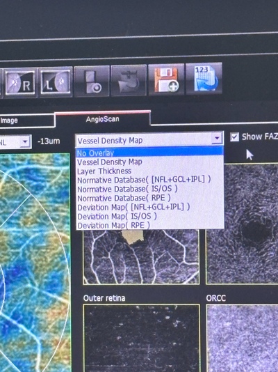 ANGIOGRAPHY Installed. No injections required. An unprecedented, high-definition 3D map of retinal blood flow drawn with light.&nbsp;|&nbsp;NIDEK&nbsp;|&nbsp;RS-3000 Advance