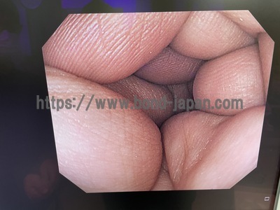 Video Colonoscope&nbsp;|&nbsp;OLYMPUS&nbsp;|&nbsp;PCF-Q260AZI