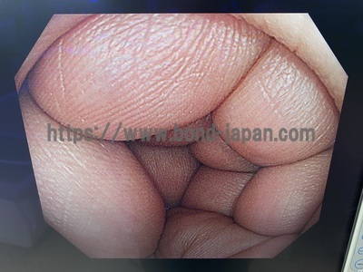 大腸スコープ&nbsp;|&nbsp;オリンパス&nbsp;|&nbsp;PCF–H290ZIの写真