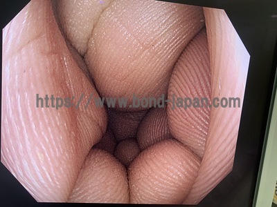 Video Colonoscope&nbsp;|&nbsp;OLYMPUS&nbsp;|&nbsp;PCF-H290ZI