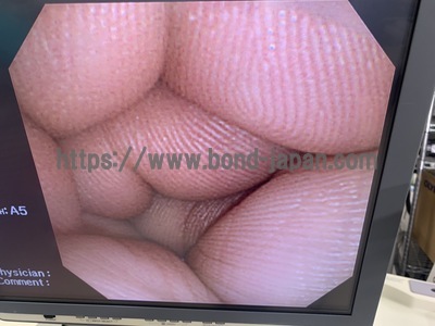 Video Gastroscope&nbsp;|&nbsp;OLYMPUS&nbsp;|&nbsp;GIF-XP260N