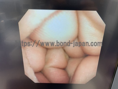 Bronchoscope&nbsp;|&nbsp;OLYMPUS&nbsp;|&nbsp;BF-1T200