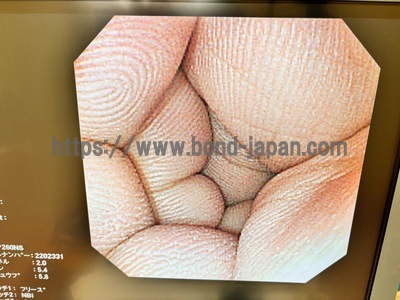 Video Gastroscope&nbsp;|&nbsp;OLYMPUS&nbsp;|&nbsp;GIF-XP260NS