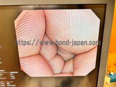 Video Colonoscope&nbsp;|&nbsp;OLYMPUS&nbsp;|&nbsp;CF-H260AI