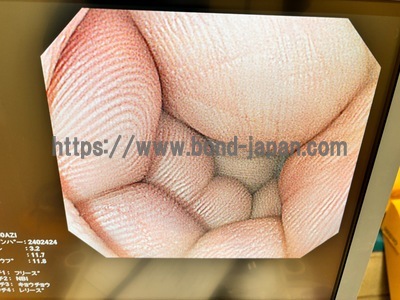 Video Colonoscope&nbsp;|&nbsp;OLYMPUS&nbsp;|&nbsp;PCF-Q260AZI