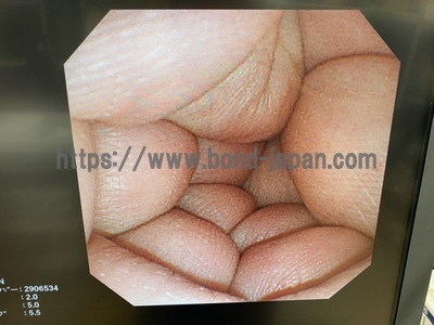 Video Gastroscope&nbsp;|&nbsp;OLYMPUS&nbsp;|&nbsp;GIF-XP260N