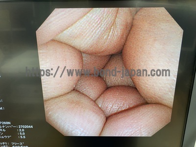 Video Gastroscope&nbsp;|&nbsp;OLYMPUS&nbsp;|&nbsp;GIF-XP260N