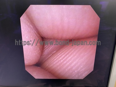 Video Ureteroscope&nbsp;|&nbsp;OLYMPUS&nbsp;|&nbsp;URF-V