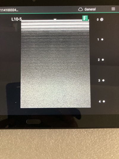 Portable Ultrasound&nbsp;|&nbsp;FUJIFILM&nbsp;|&nbsp;iViz air Linear